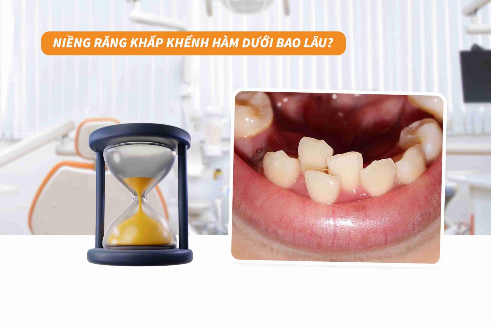 Niềng răng khấp khểnh hàm dưới bao lâu? 