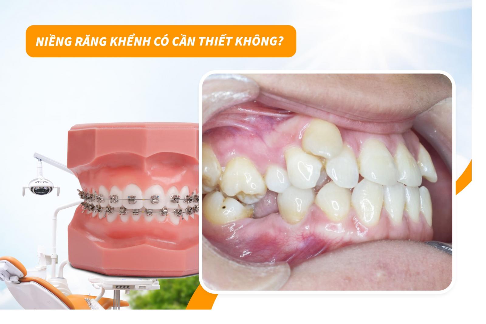 Niềng răng khểnh có cần thiết không?