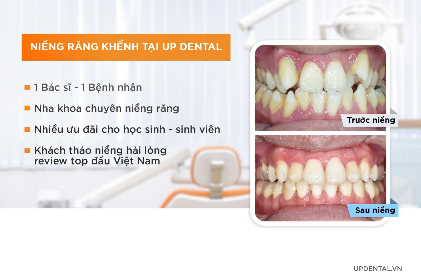 niềng răng khểnh tại Up Dental