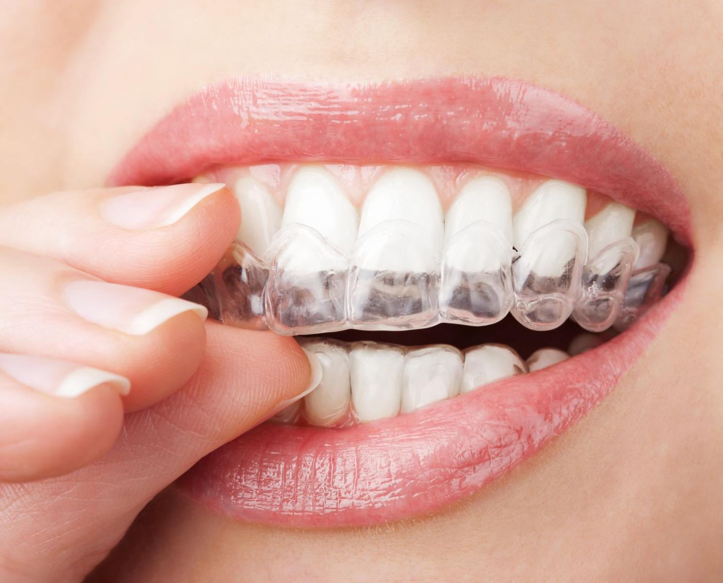 phương pháp niềng răng Invisalign
