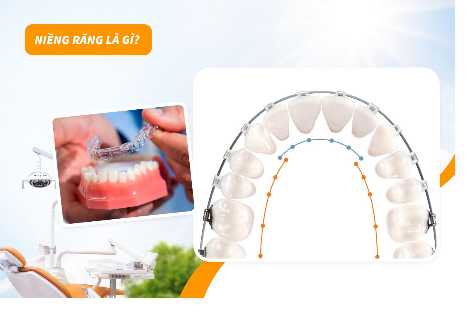 Niềng răng là gì?