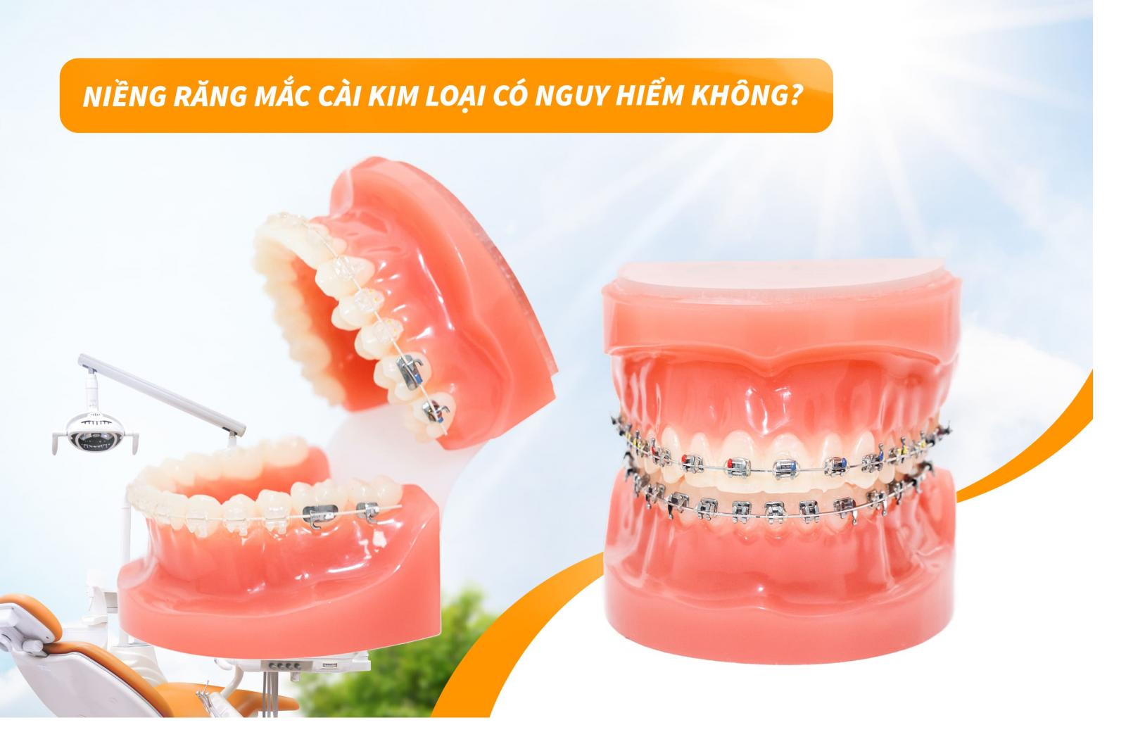 Niềng răng mắc cài kim loại có nguy hiểm không?