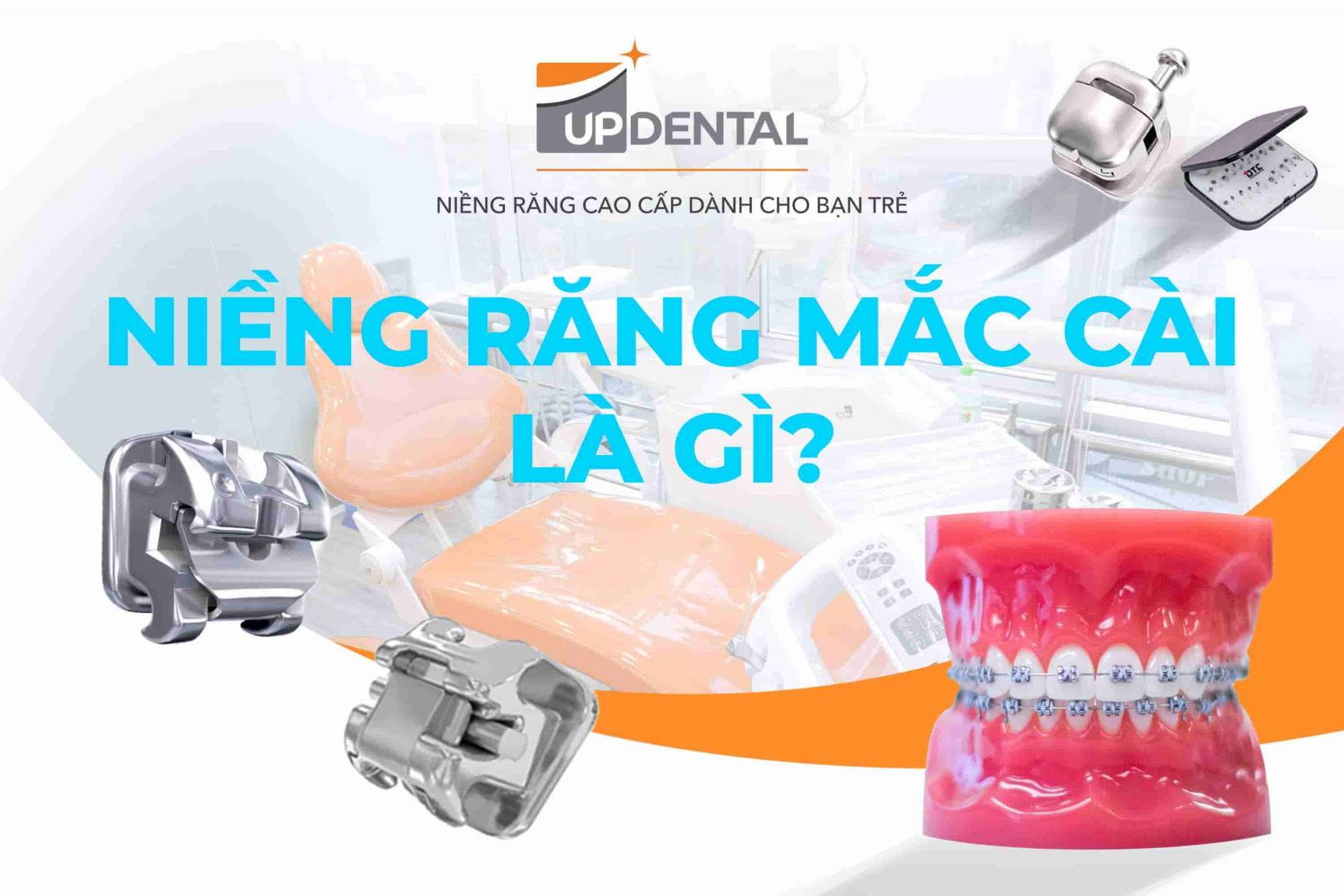 Niềng răng mắc cài là gì?