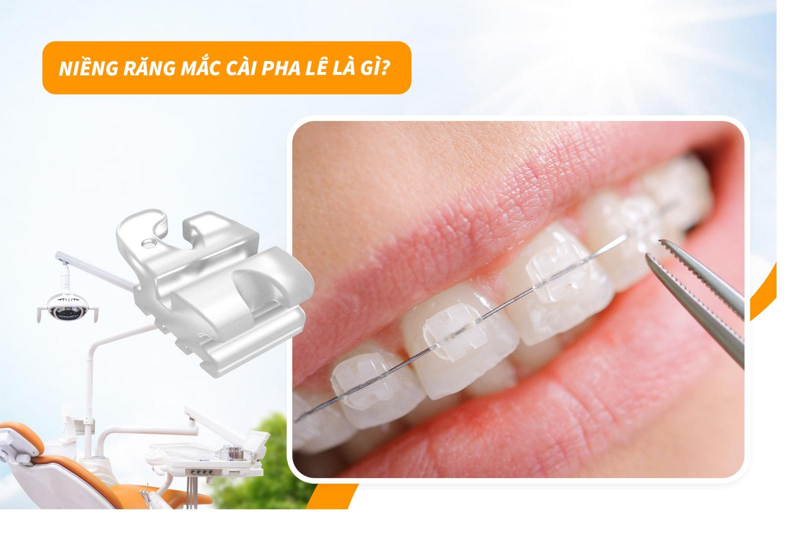 Niềng răng mắc cài pha lê là gì?