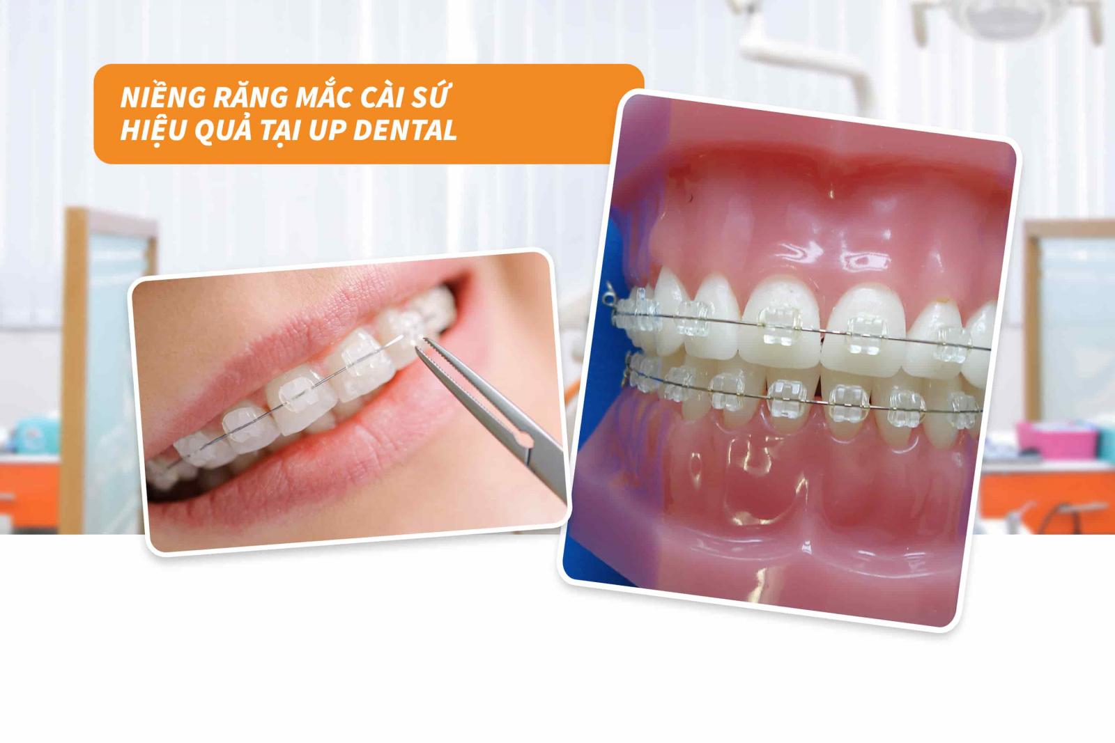 Niềng răng mắc cài sứ hiệu quả tại Up Dental