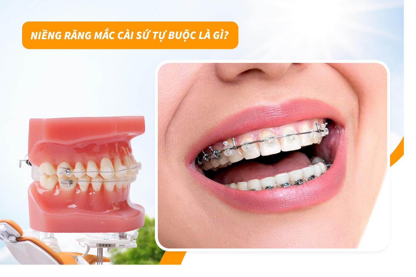 Niềng răng mắc cài sứ tự buộc là gì?