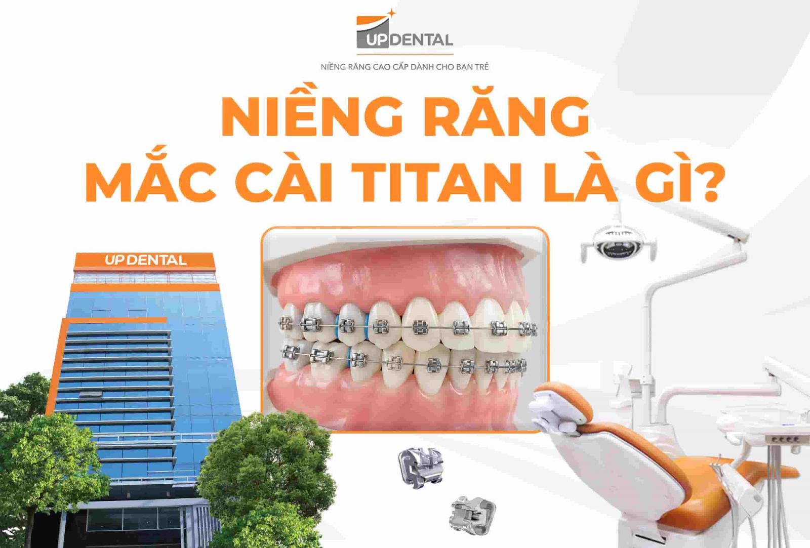 Niềng răng mắc cài Titan là gì?