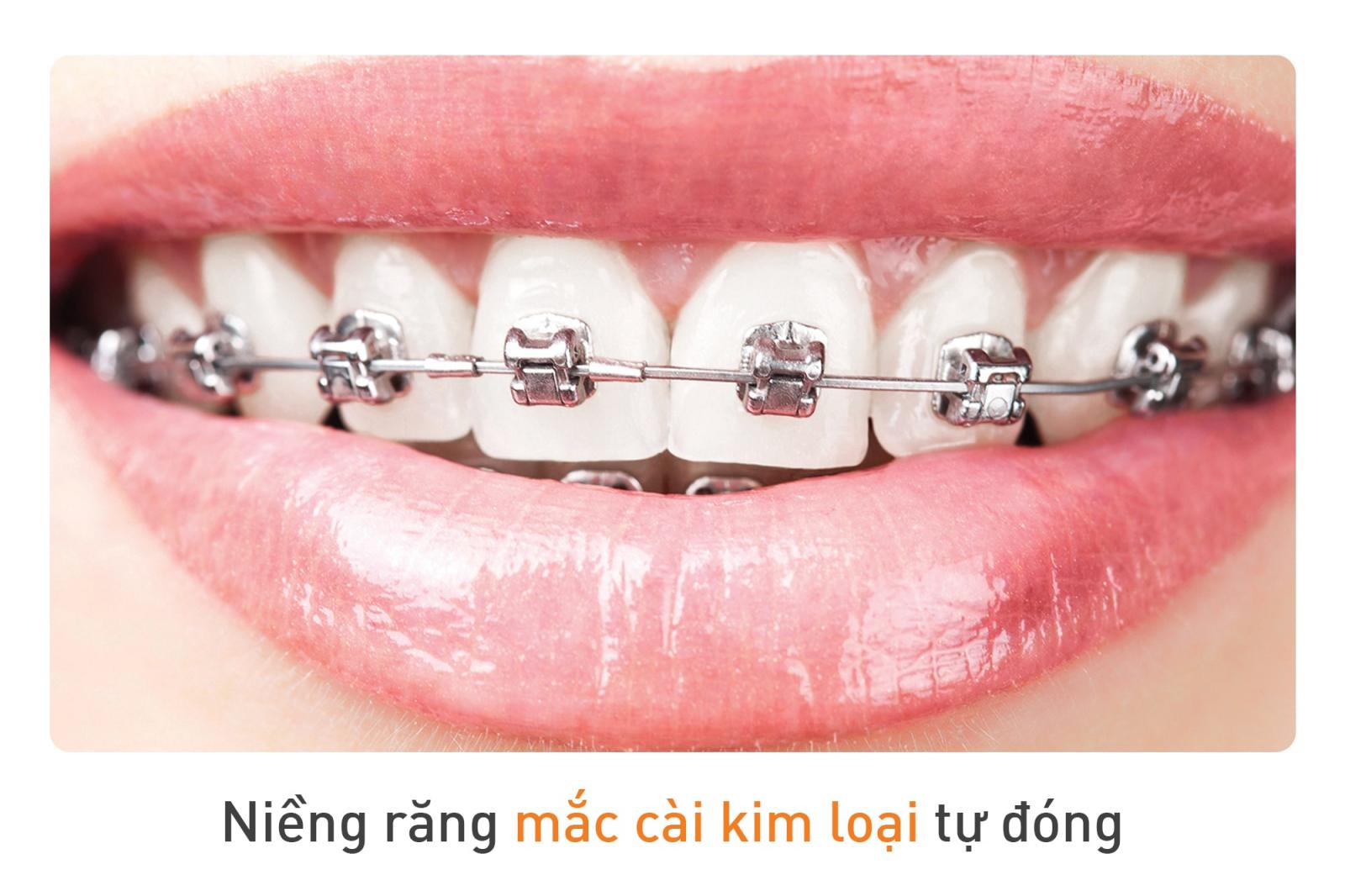 Niềng răng mắc cài kim loại tự buộc/ tự đóng có tốt không? | Up Dental