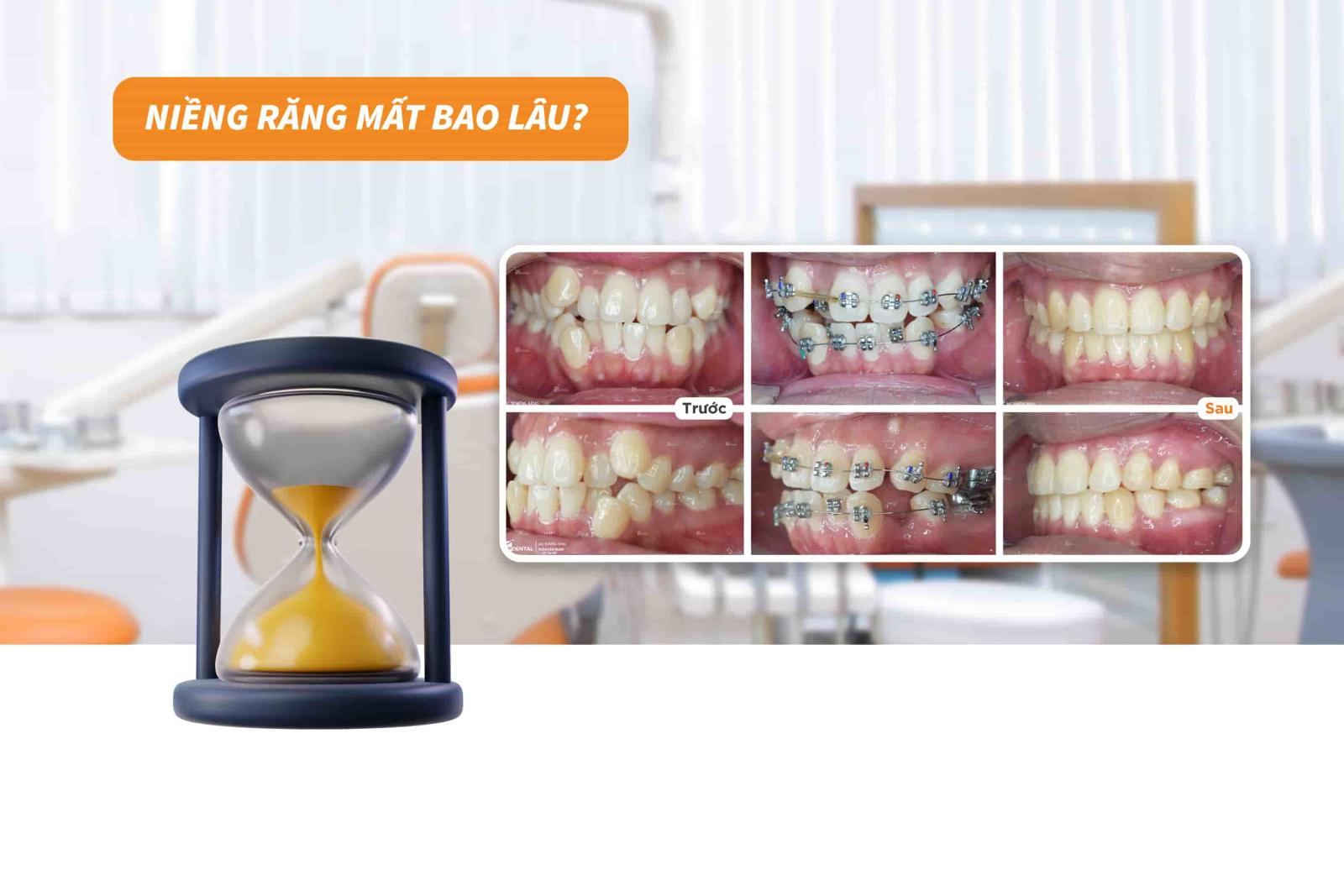 Niềng răng mất bao lâu? 