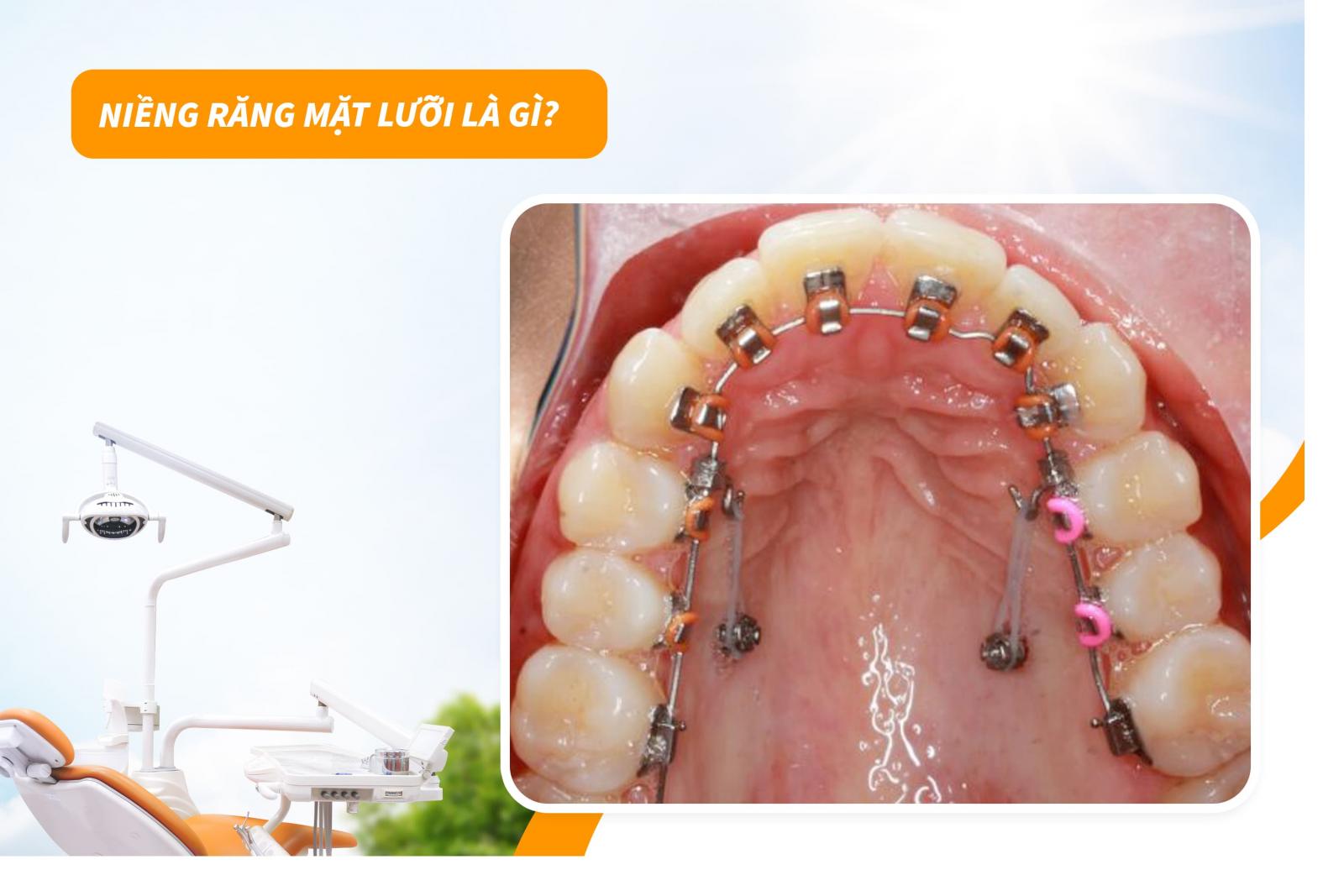 Niềng răng mặt lưỡi là gì?