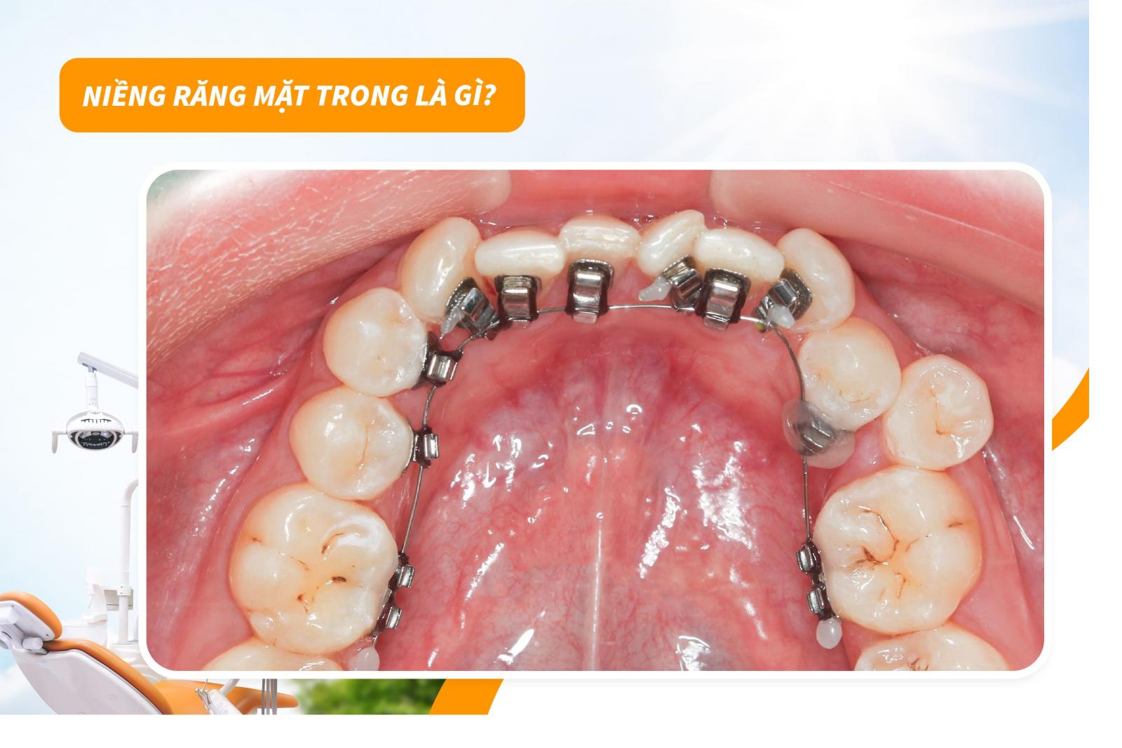 Niềng răng mặt trong là gì?