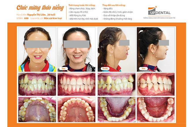 Sự thay đổi trước và sau khi niềng