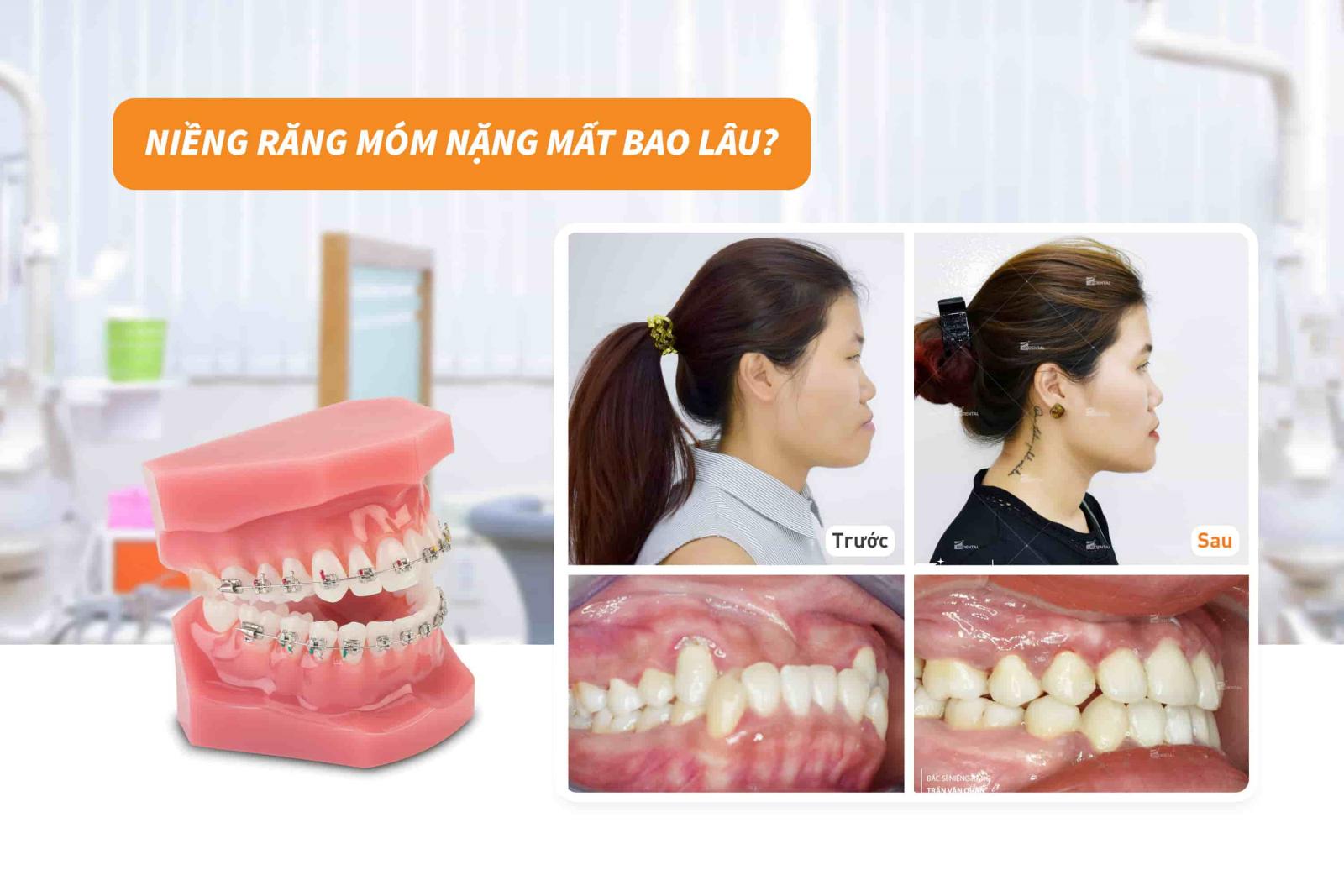 Niềng răng móm nặng mất bao lâu?