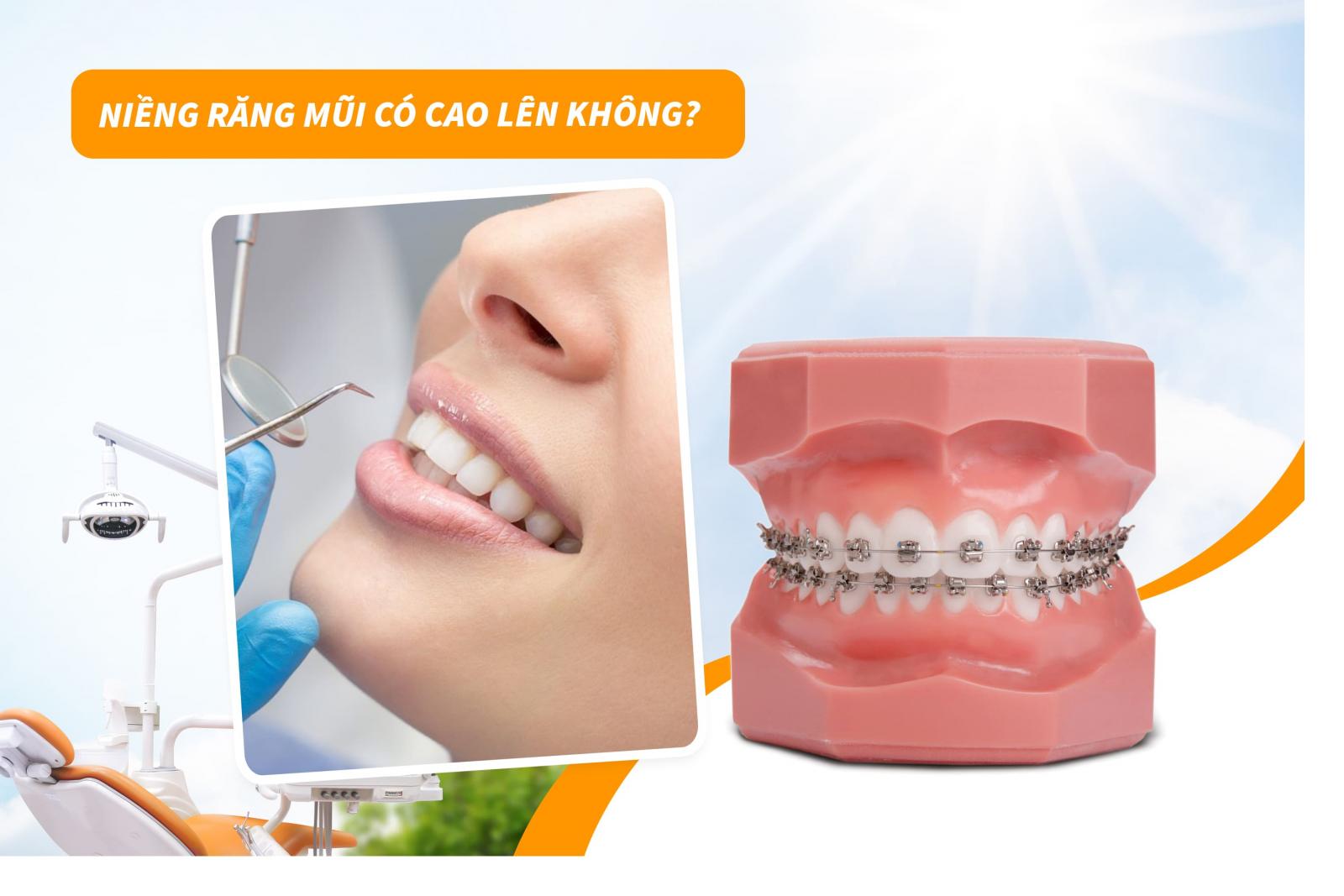 Niềng răng mũi có cao lên không?