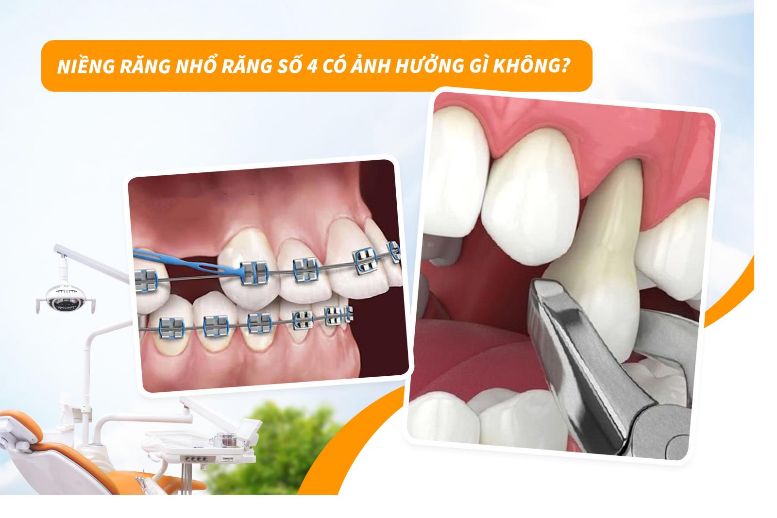 Niềng răng nhổ răng số 4 có ảnh hưởng gì không?