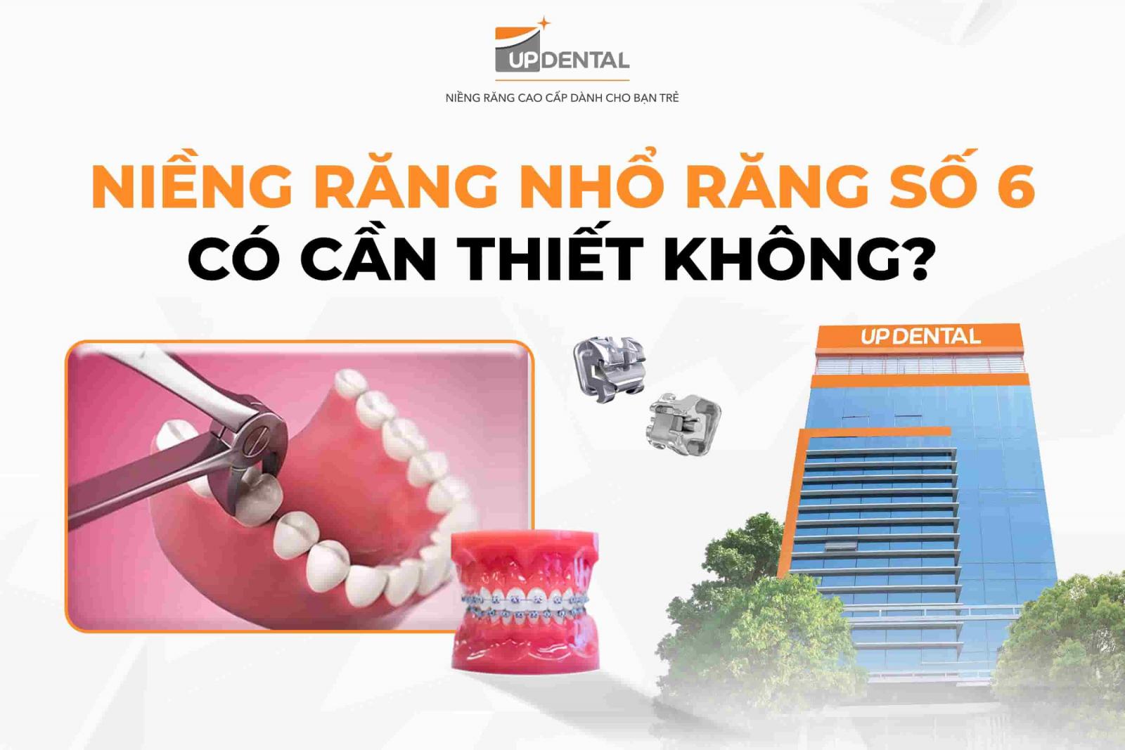 Niềng răng nhổ răng số 6 có cần thiết không?