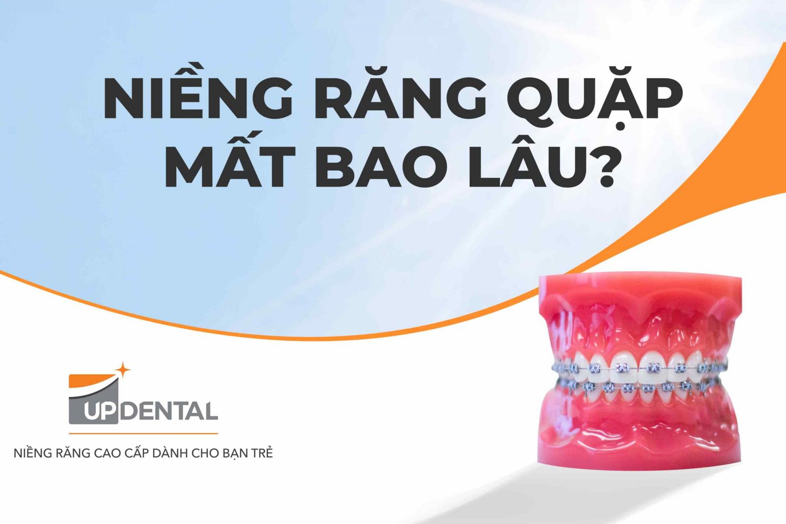 Niềng răng quặp mất bao lâu?