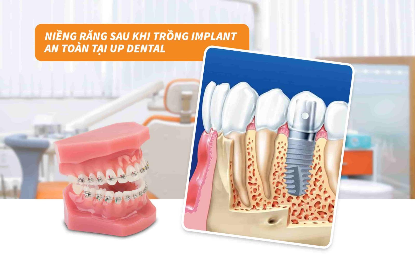 Niềng răng sau khi trồng Implant an toàn tại Up Dental