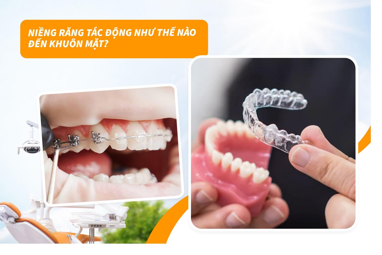 Niềng răng tác động như thế nào đến khuôn mặt?