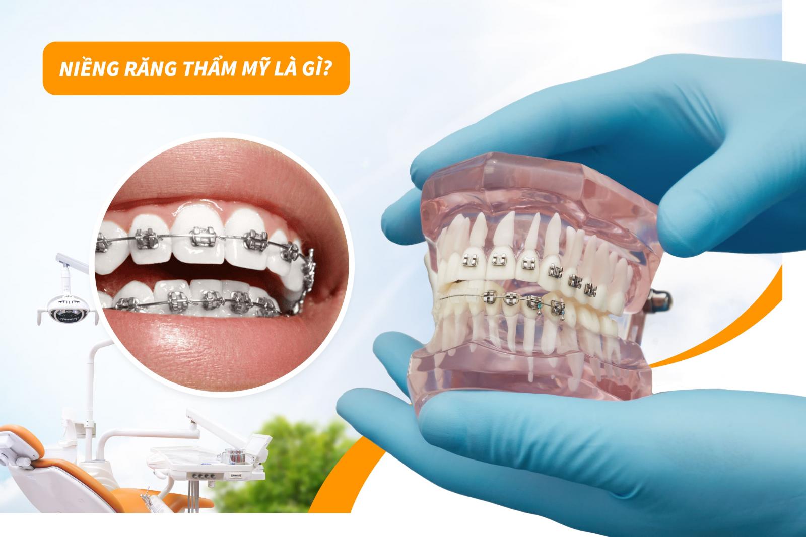 Niềng răng thẩm mỹ là gì?