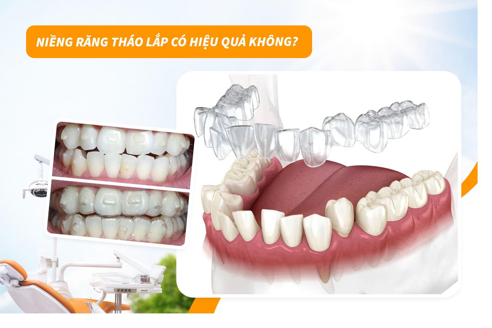 Niềng răng tháo lắp có hiệu quả không?
