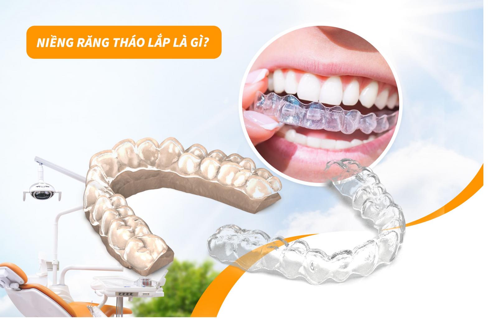 Niềng răng tháo lắp là gì?