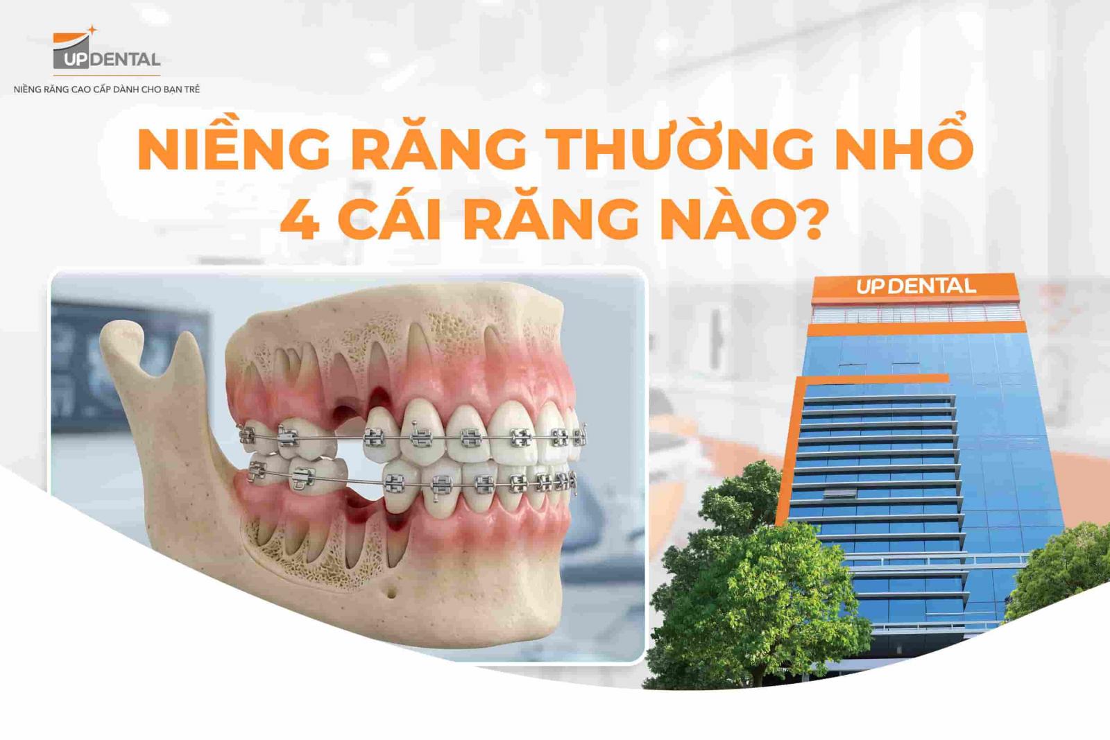 Niềng răng thường nhổ 4 cái răng nào?