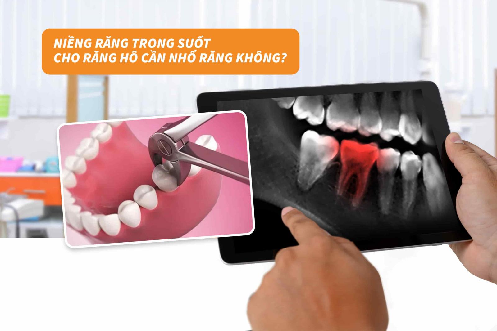 3. Niềng răng trong suốt cho răng hô cần nhổ răng không?