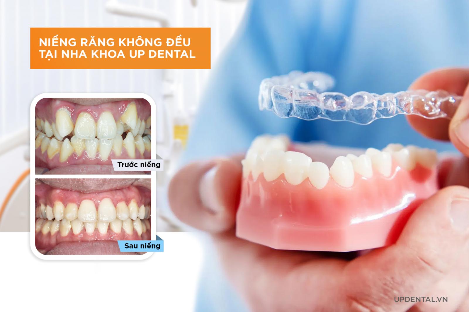 Niềng răng không đều an toàn tại Up Dental