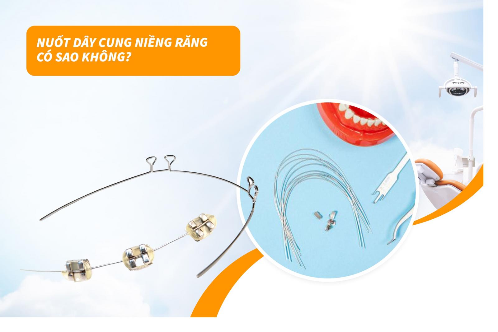 Nuốt dây cung niềng răng có sao không?