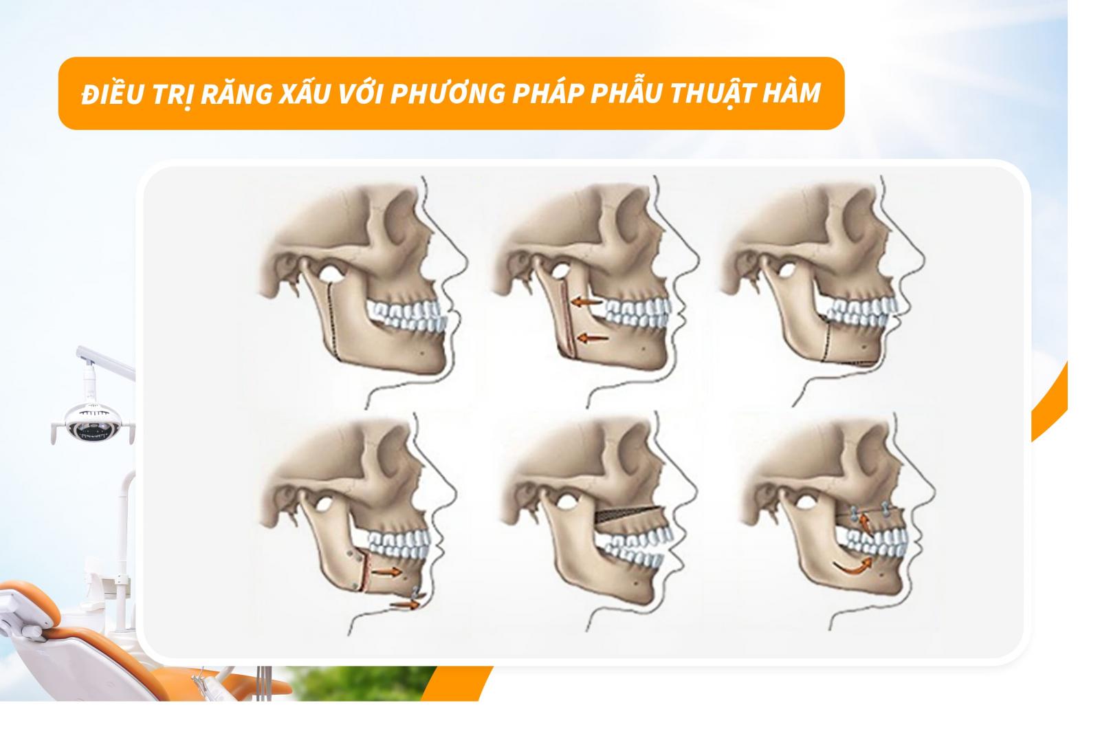 Điều trị răng xấu với phương pháp phẫu thuật hàm