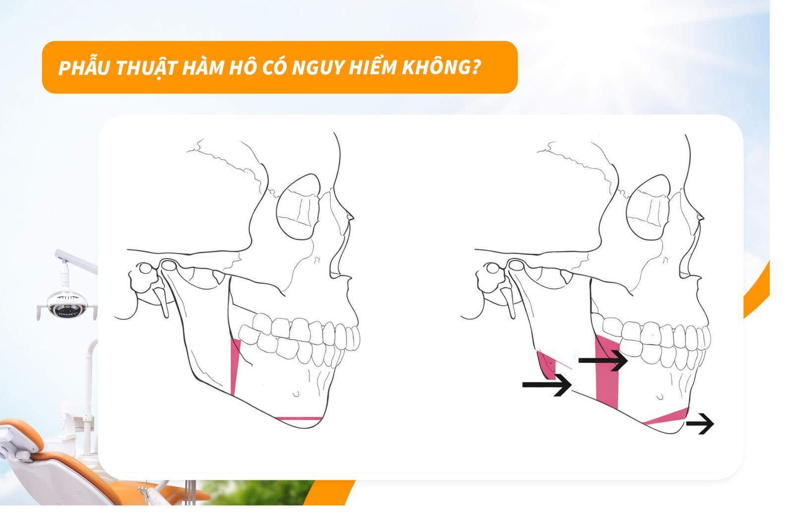 Phẫu thuật hàm hô có nguy hiểm không?