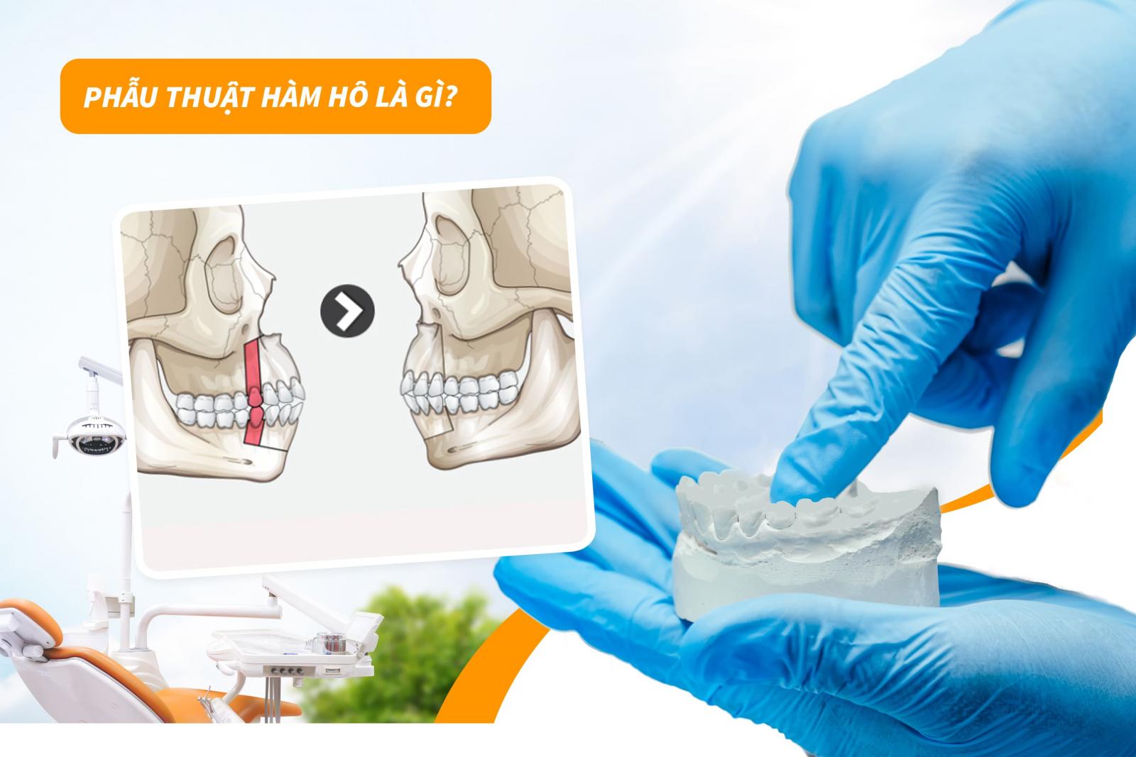 Phẫu thuật hàm hô là gì?