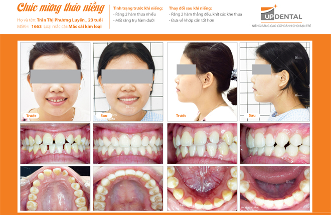 Hình ảnh trước và sau khi niềng
