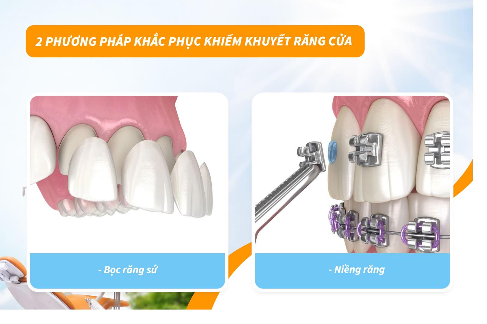 2 phương pháp khắc phục khiếm khuyết răng cửa