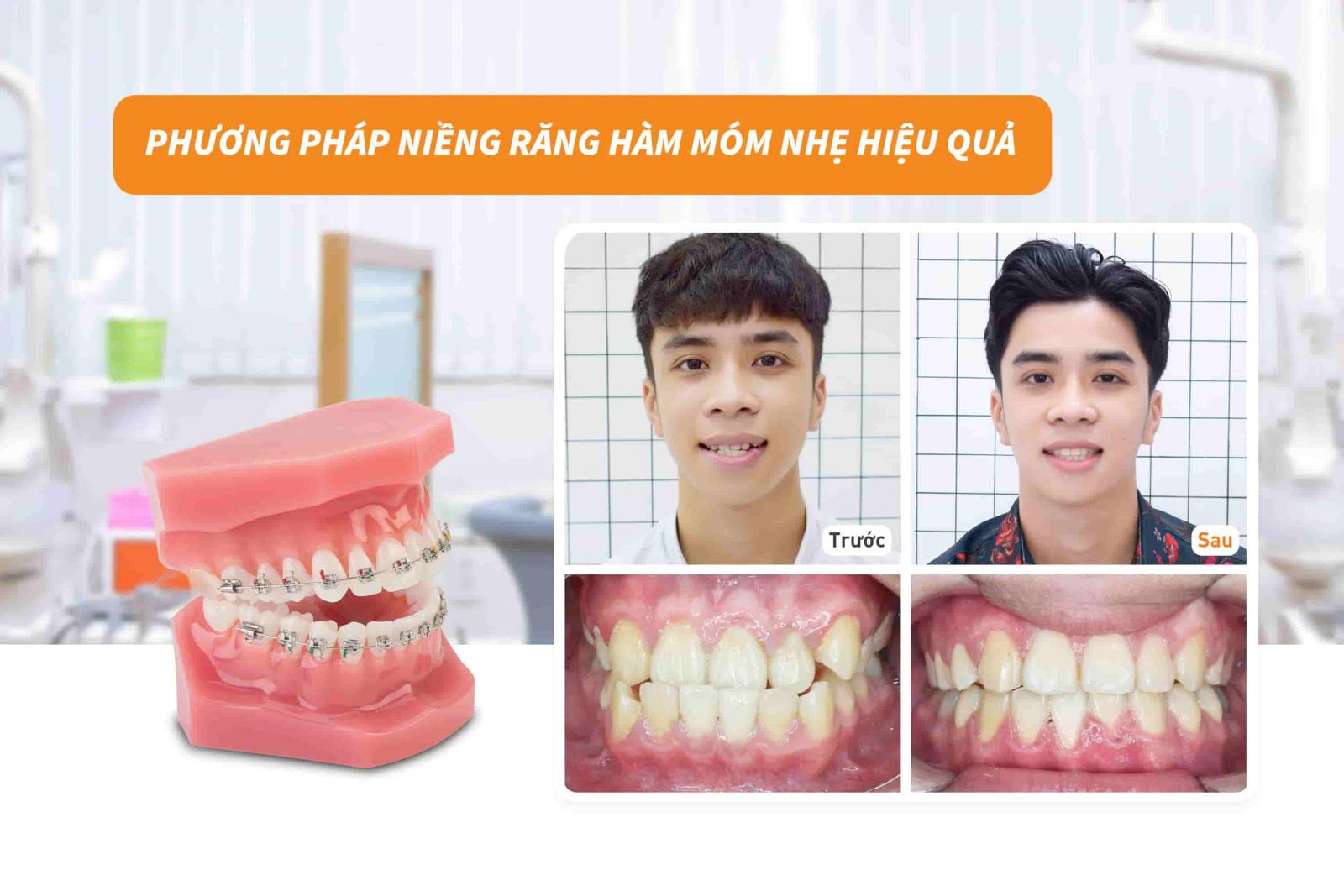 Phương pháp niềng răng hàm móm nhẹ hiệu quả