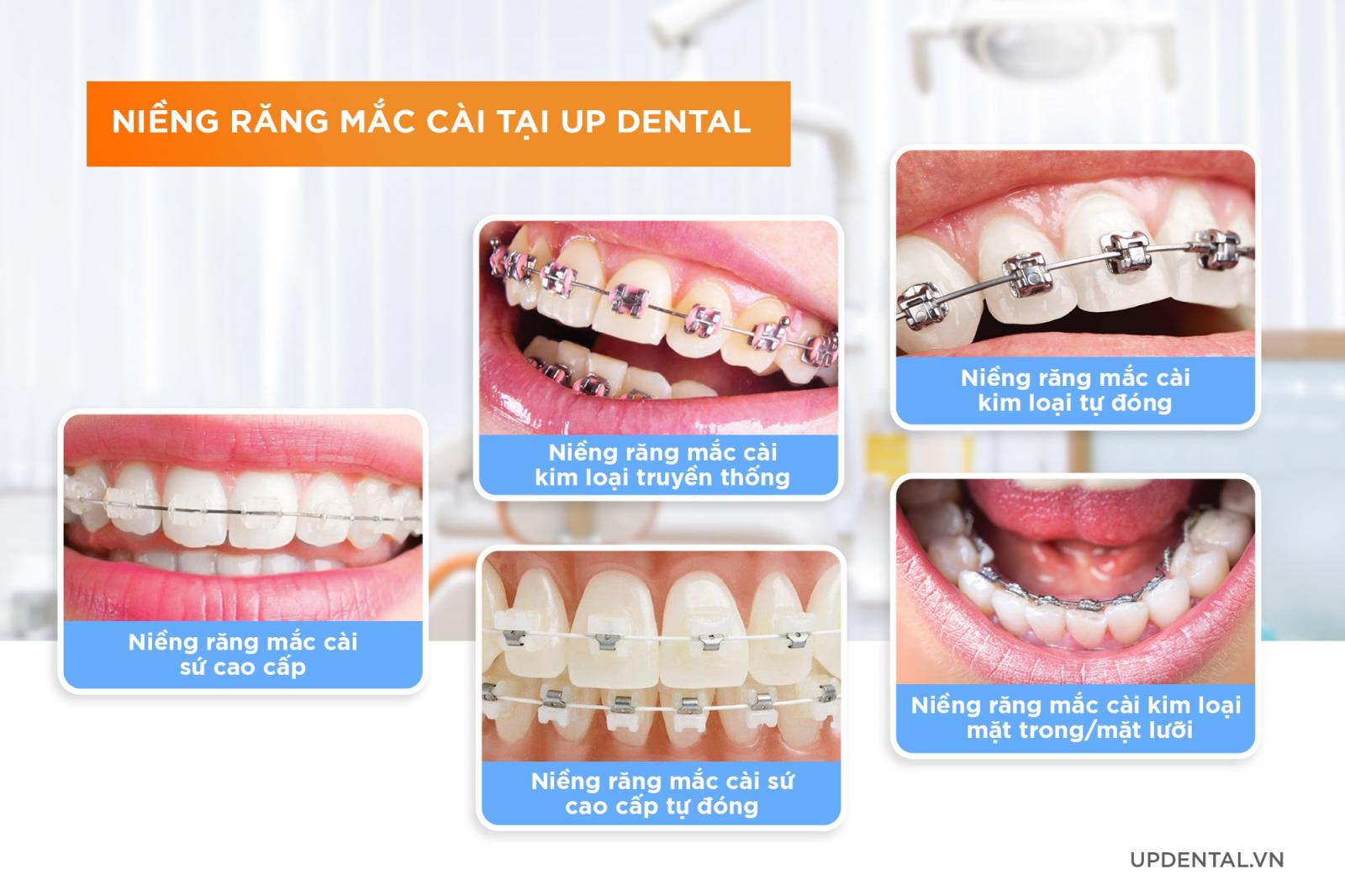 các phương pháp niềng răng mắc cài tại Up Dental