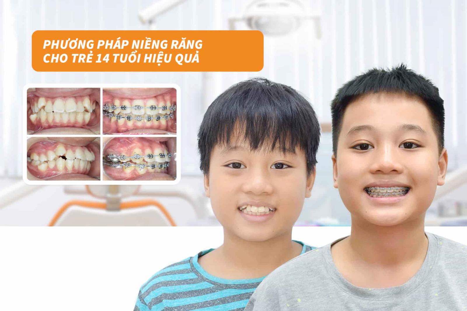 Phương pháp niềng răng cho trẻ 14 tuổi hiệu quả