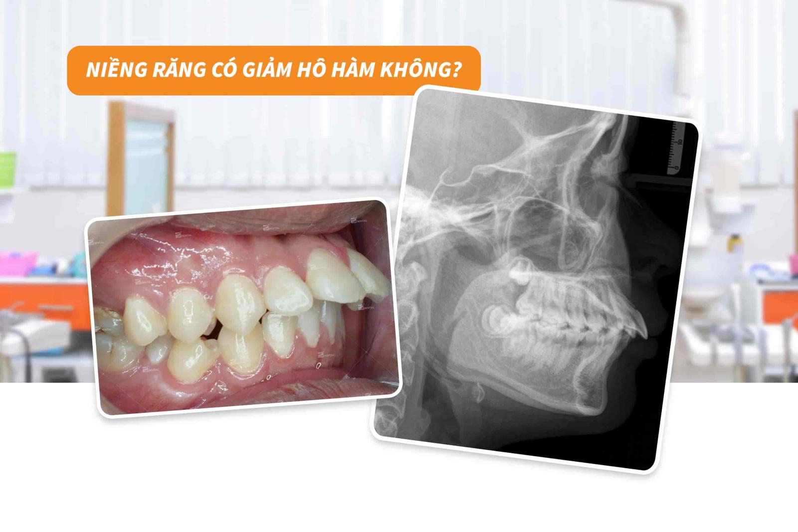 Niềng răng có giảm hô hàm không?