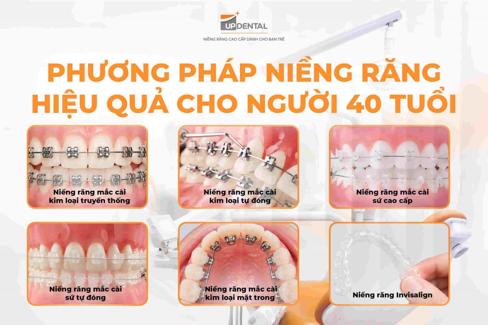 Phương pháp niềng răng hiệu quả cho người 40 tuổi
