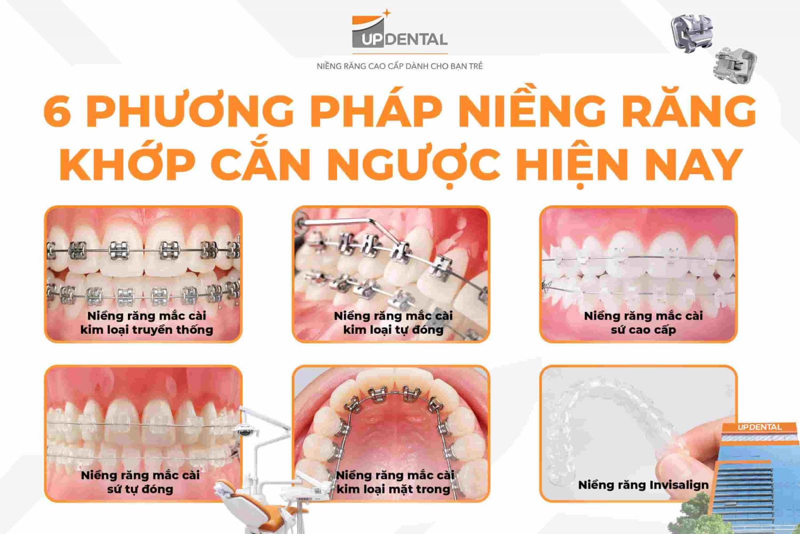 6 phương pháp niềng răng khớp cắn ngược hiện nay