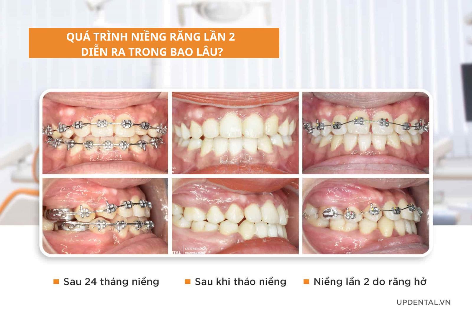 Quá trình niềng răng lần 2 diễn ra trong bao lâu