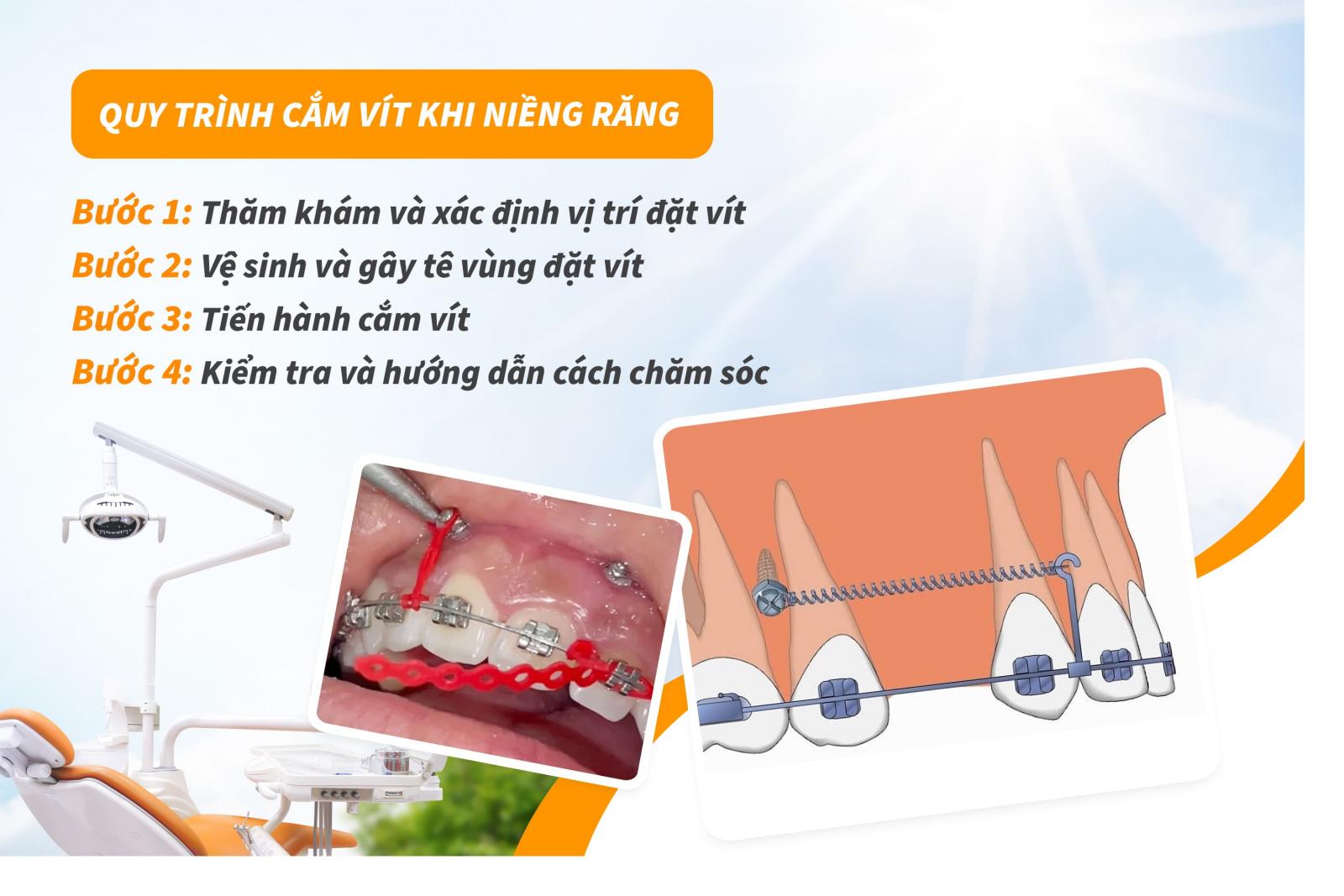 Quy trình cắm vít khi niềng răng