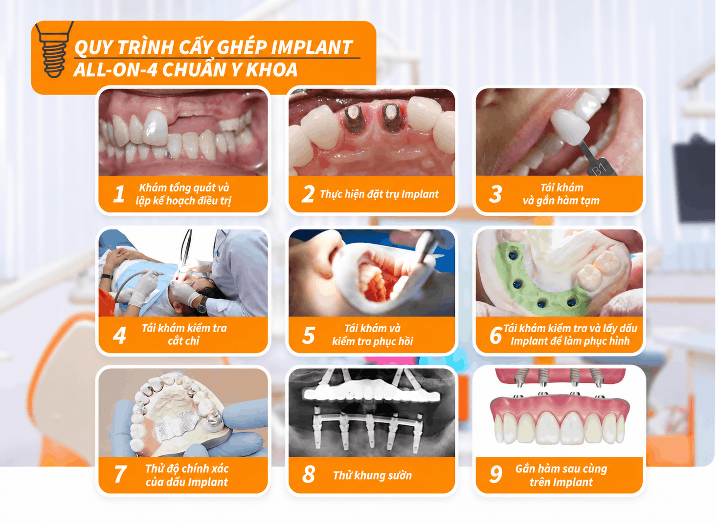 Quy trình cấy ghép Implant all-on-4 chuẩn Y khoa