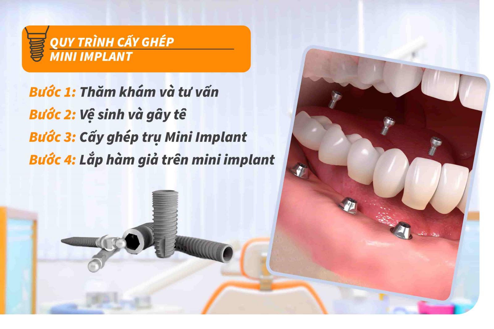 Quy trình cấy ghép Mini Implant