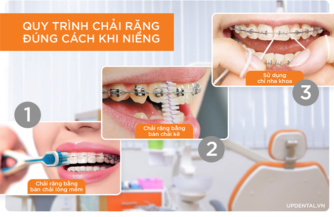 Quy trình chải răng đúng cách khi niềng răng