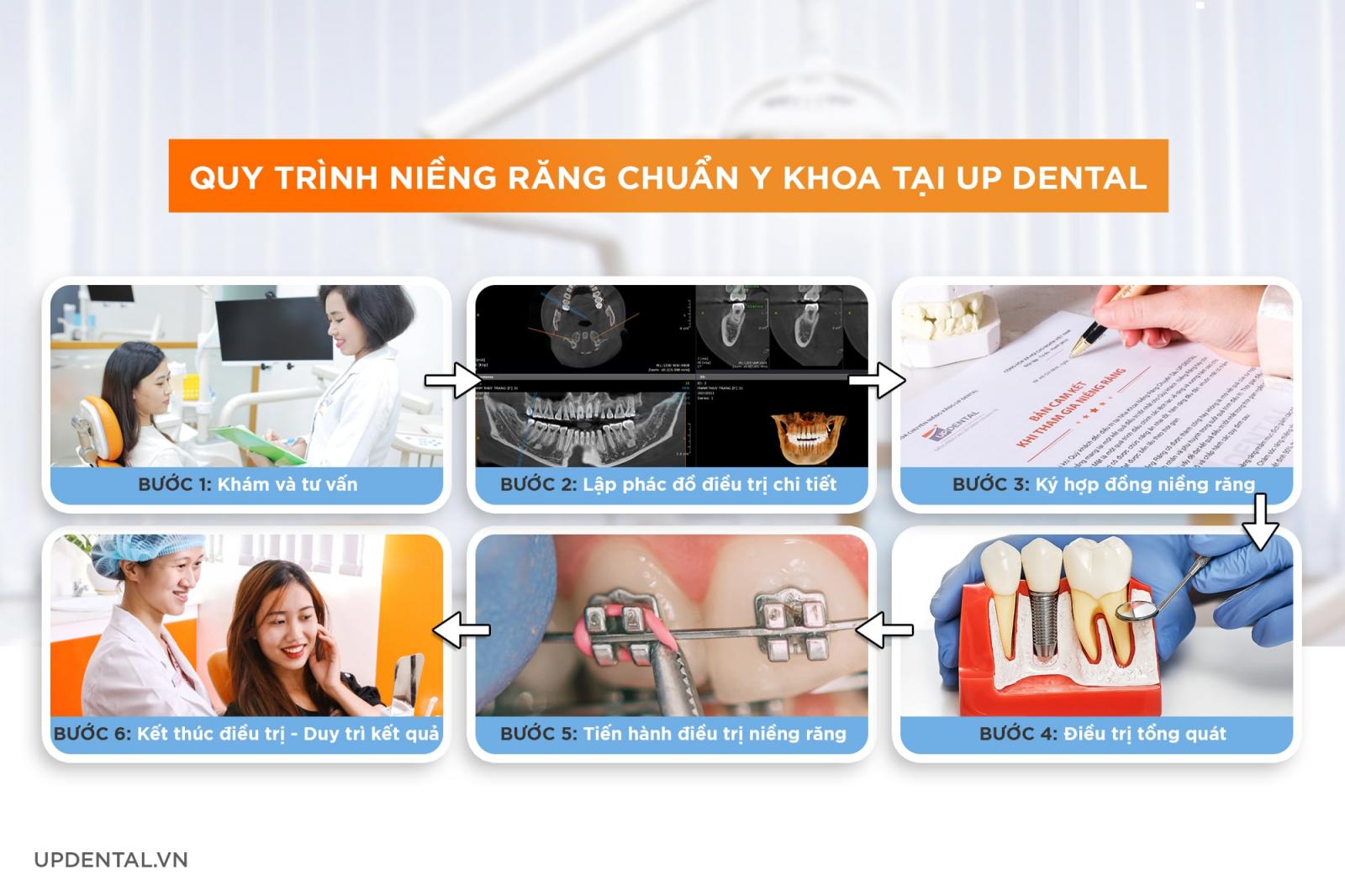 quy trình niềng răng chuẩn y khoa Up Dental