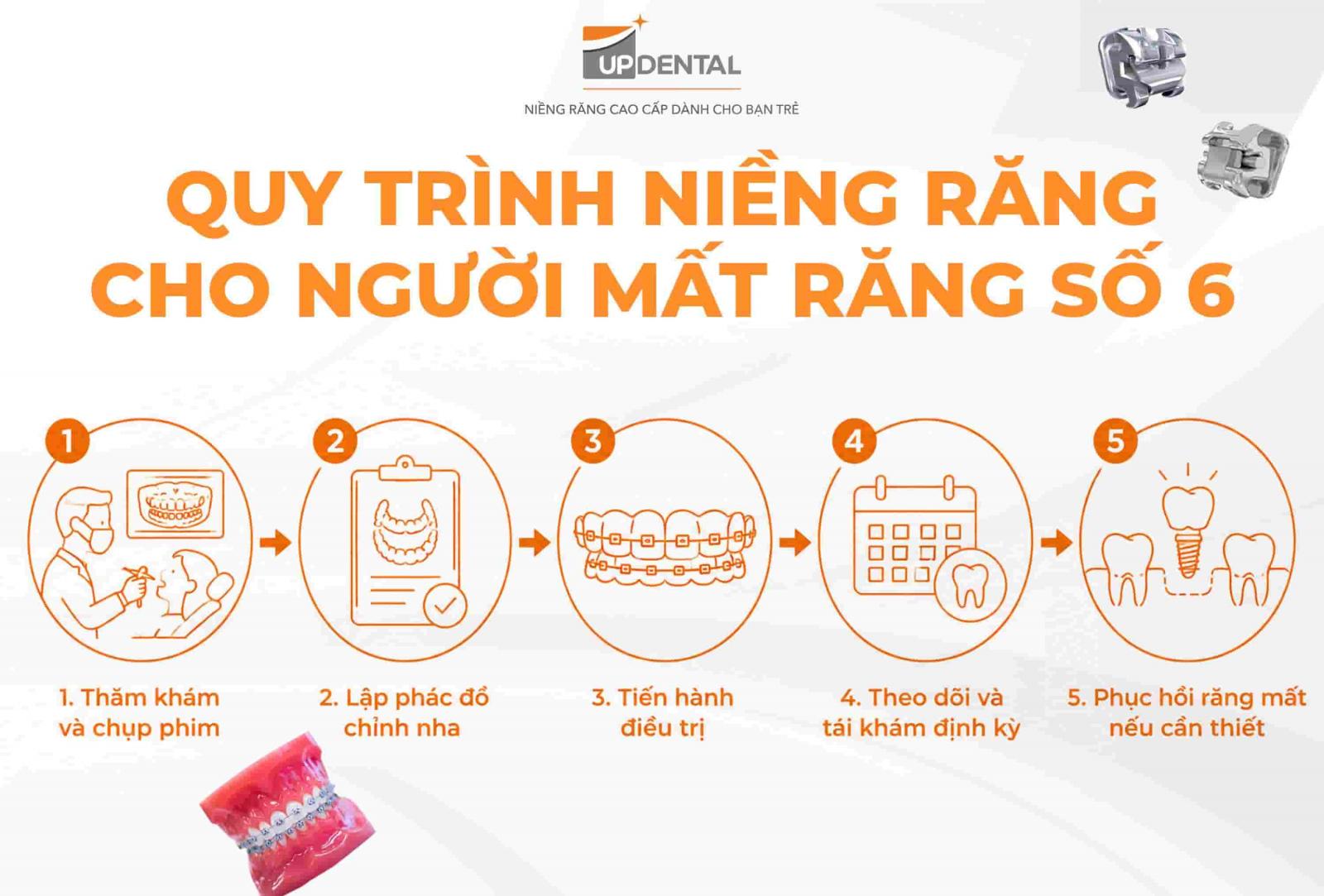 Quy trình niềng răng cho người mất răng số 6