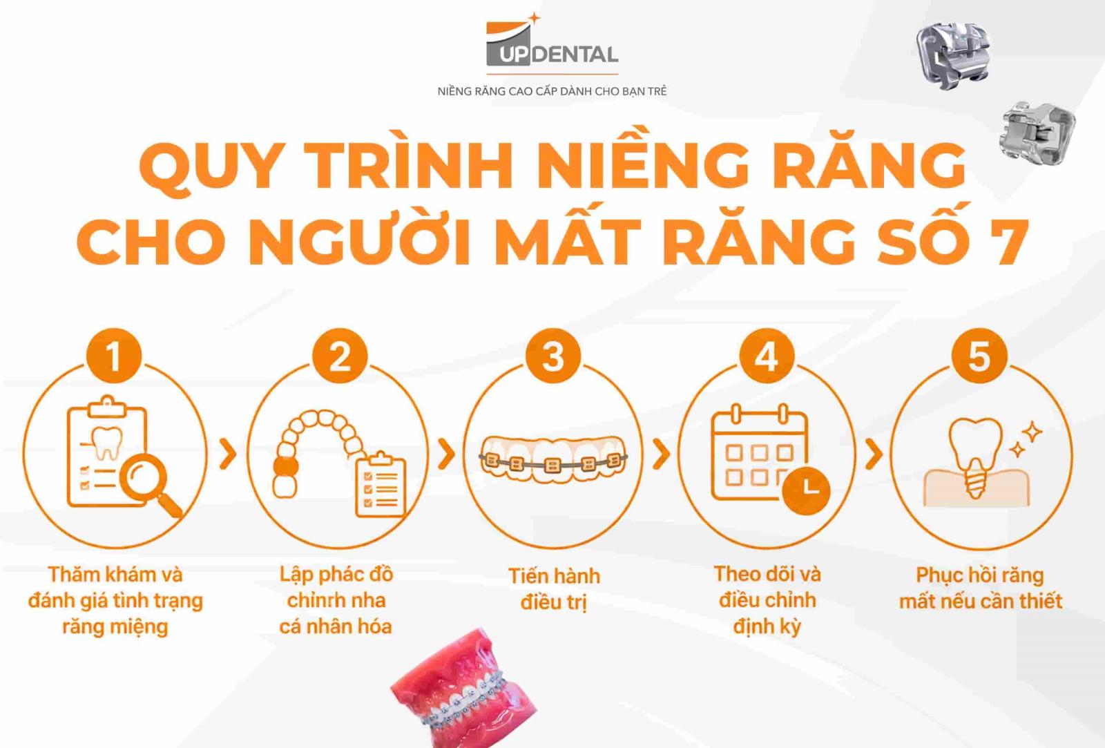 Quy trình niềng răng cho người mất răng số 7
