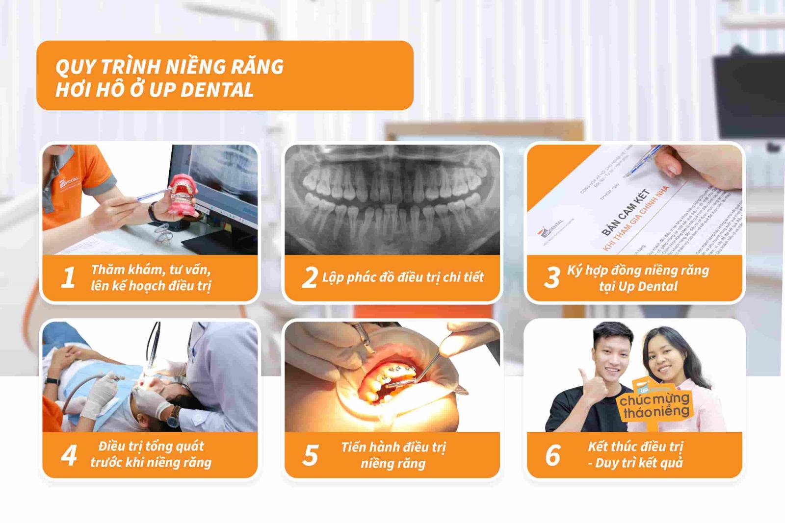 Quy trình niềng răng hơi hô ở Up Dental